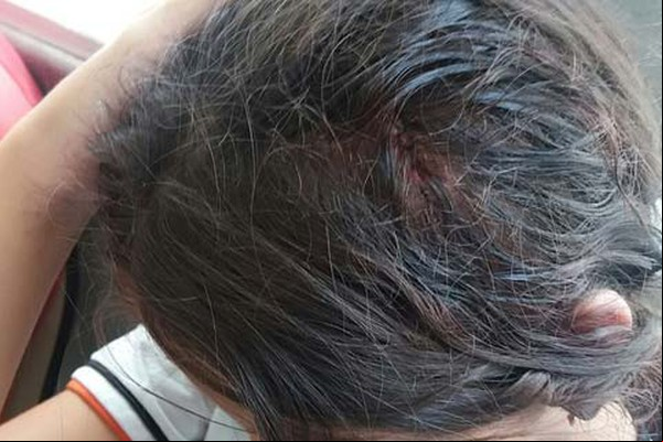 Portão desaba na Escola Estadual Abner Afonso e deixa ferida estudante de 13 anos 