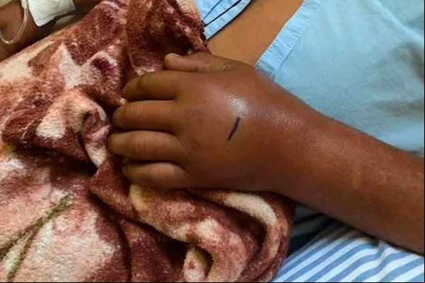 Aposentado tem que ar por cirurgia após ser acometido por bactéria e pede ajuda para custear tratamento