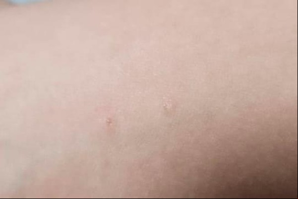 Garoto de 9 anos é mordido por morcego enquanto tomava banho em Patos de Minas