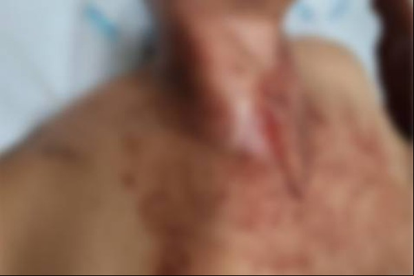 Homem é atingido por “espeto” no pescoço, mas pede para não prender acusado