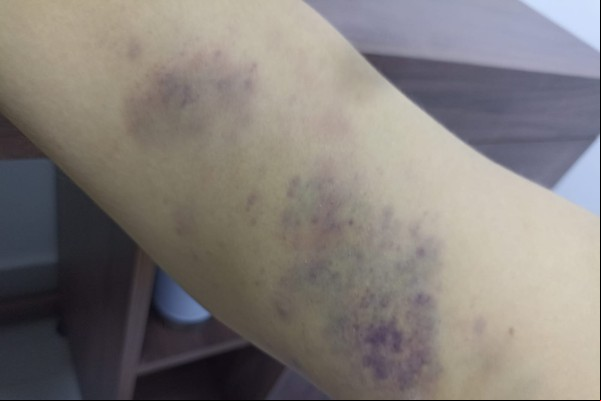 Cliente alega ter sido agredido por seguranças de supermercado em Patos de Minas